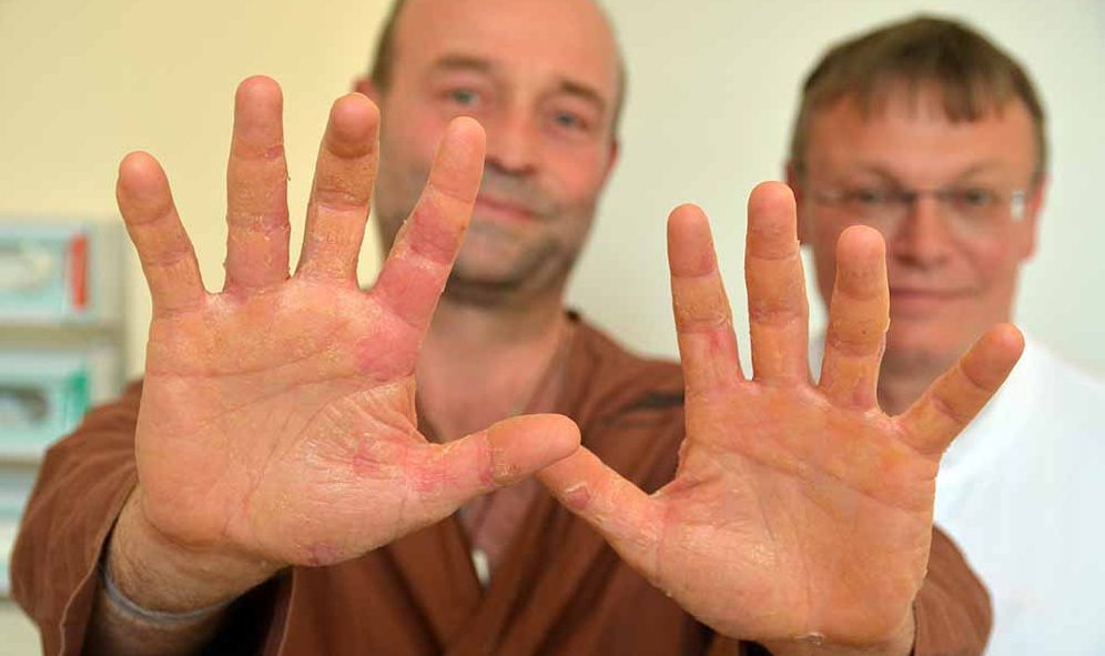 Das Foto zeigt den Patienten mit der bereits abgeklungenen Hauterkrankung und Oberarzt Dr. Hartmut Ständer.