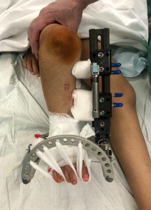 Durch den Eingriff im Klinikum Dortmund konnte eine Beinamputation verhindert werden.