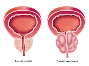 Krankhafte Veränderungen der Prostata - sie sorgen für 25 Prozent der Krebserkrankungen bei Männern.